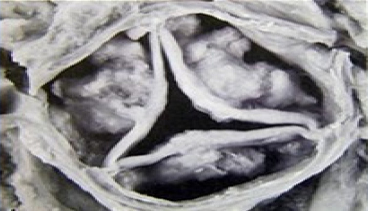 Aort kapak darlığı nasıl anlaşılır