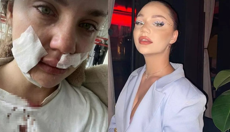 Ünlü fenomen Cansu Yeğin'e köpeği saldırdı. Yüzünü paramparça etti