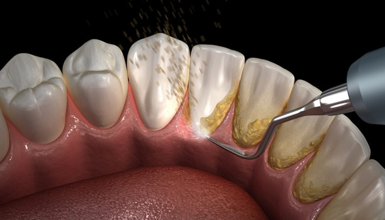 Evde diş taşlarından nasıl kurtulursunuz