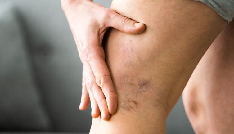 Varis nedir? Varis tedavi yöntemleri neler?