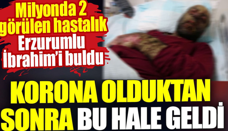 Korona olduktan sonra bu hale geldi. Milyonda 2 görülen hastalık Erzurumlu İbrahim’i buldu