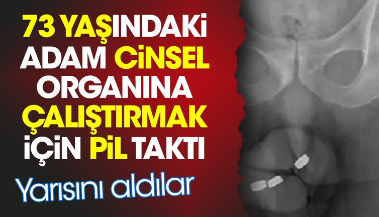 73 yaşındaki adam cinsel organına çalıştırmak için pil taktı. Yarısını aldılar