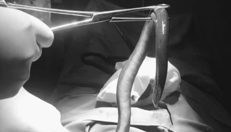 Karın ağrısıyla gitti karnından 30 cm yılan balığı çıktı. Vücuduna girdiği yer doktorları şaşkına çevirdi