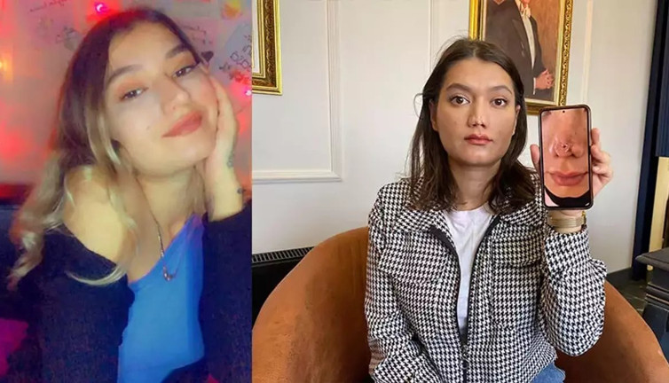 Estetik ameliyatı sonrası hayatı kâbusa döndü! Burnu çöktü milyonluk tazminat davası açtı