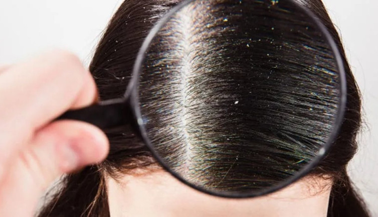 Kepek problemi ve çözümleri: Neden oluşur ve nasıl önlenir?