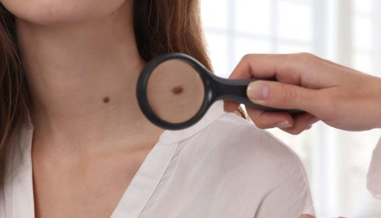 Cilt kanserine karşı 'Ben Taramasına' uzmanlar ne diyor?