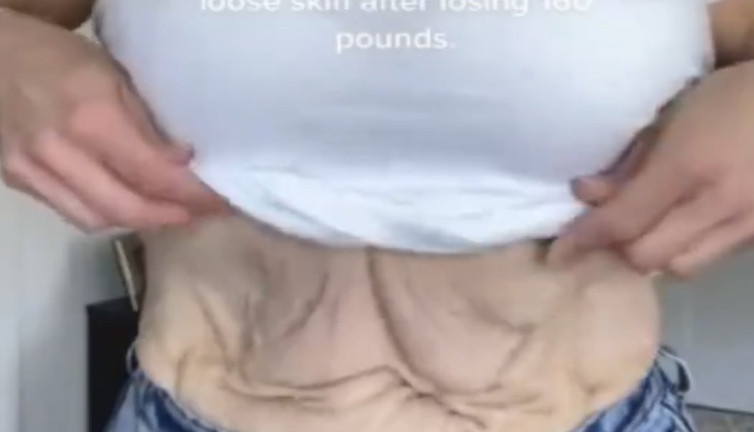 Kilo veren kadının vücudundaki deformasyon