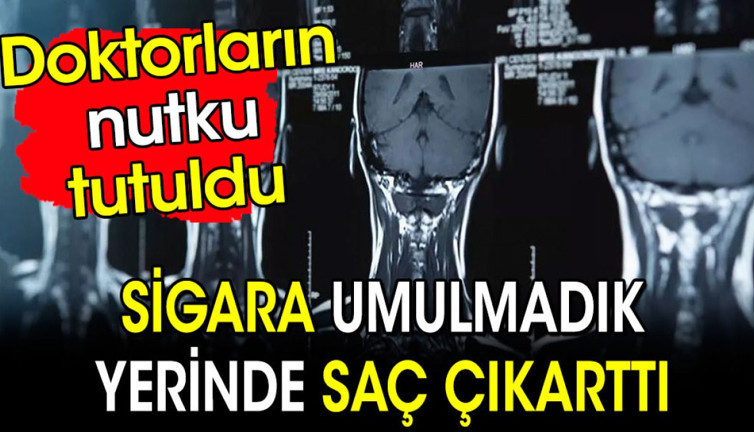 Sigara umulmadık yerinde saç çıkarttı! Doktorların nutku tutuldu