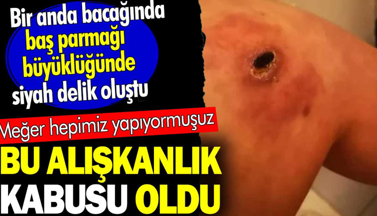 Bu alışkanlık kabusu oldu. Bir anda bacağında baş parmağı büyüklüğünde siyah delik oluştu