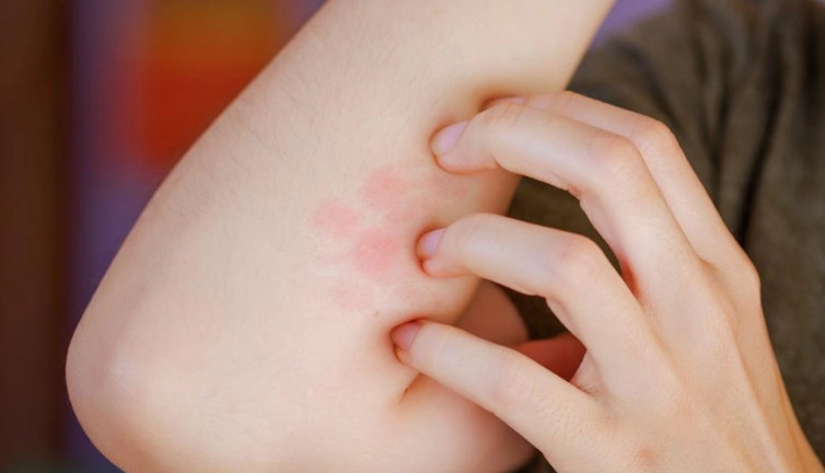 Yazın böcek ısırığı alerjileriyle ilgili uzman uyarıları