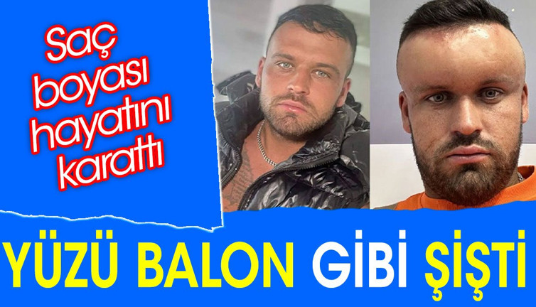 Yüzü balon gibi şişti. Saç boyası hayatını karattı