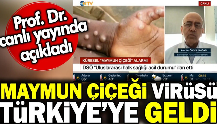 Maymun çiçeği virüsü Türkiye'ye geldi! Prof. Dr. canlı yayında açıkladı