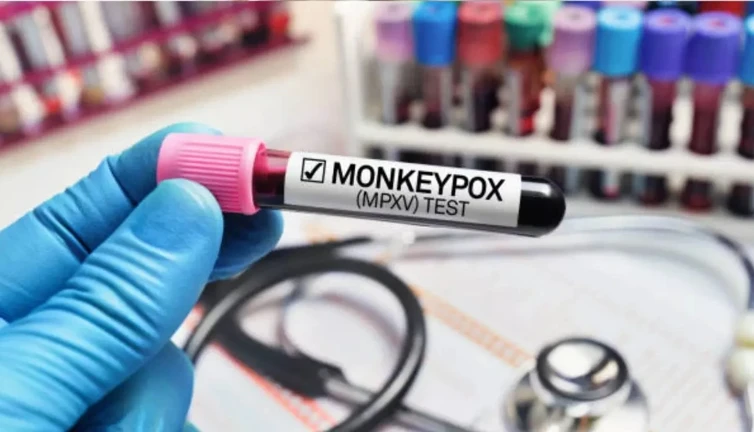 İsveç ilk maymun çiçeği vakasını bildirdi