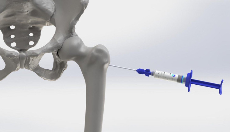 Denosumab tedavisi: kemik hastalarının umudu