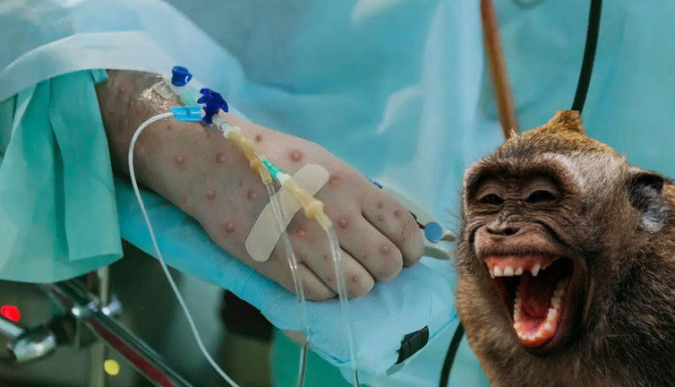 Daha bulaşıcı! Maymun çiçeği virüsünün yeni varyantı tespit edildi