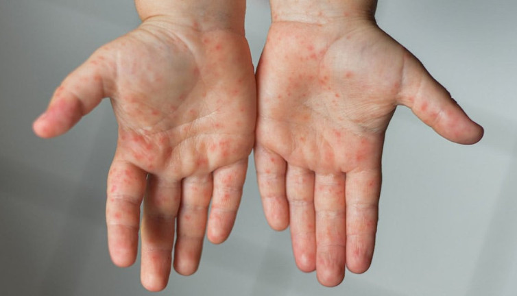 El-ayak-ağız hastalığı erişkinlere bulaşır mı? Uzmanlar ve bilim bu konuda ne söylüyor?