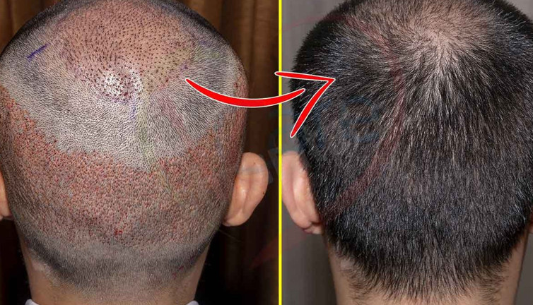 Saç ekimi mevcut saçlara zarar verir mi? Uzmanlar ve bilim bakın ne diyor!