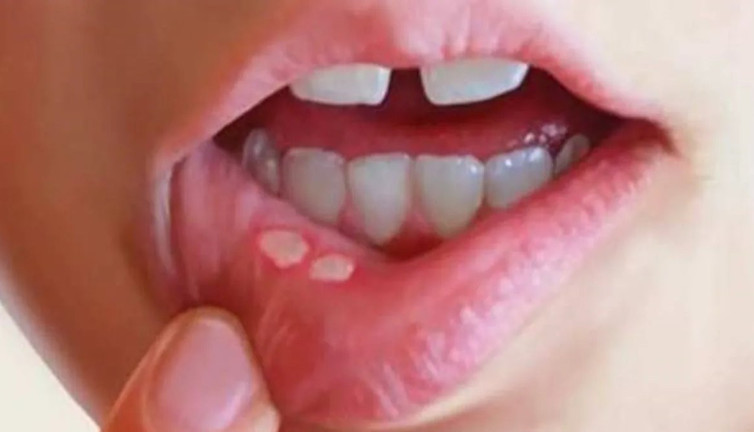 Ağız yaraları ve asabi çıkışlara dikkat! Uzmanlar uyardı!