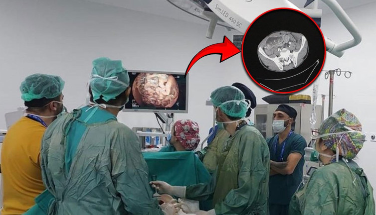 Katı gıdaları yedikten sonra kusuyordu! 10 kattan fazla büyüyen midesi doktorları bile şaşırttı