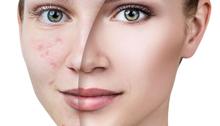 Cilt lekelerinden kurtulmanın doğal yolları... İşte bilimsel araştırmalar ve uzman görüşleri