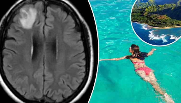 Beyninde gizlenen parazit kabusu oldu: Tatil dönüşü acı gerçekle karşılaştı