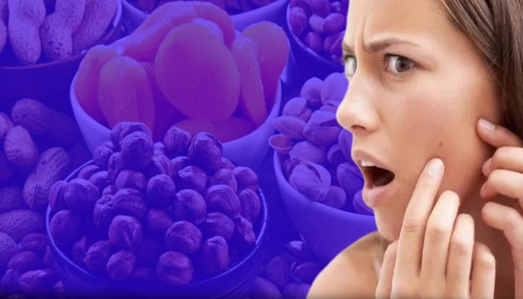 Sivilceyi tetikleyen 10 besin! Uzmanlar uyarılarını sıraladı