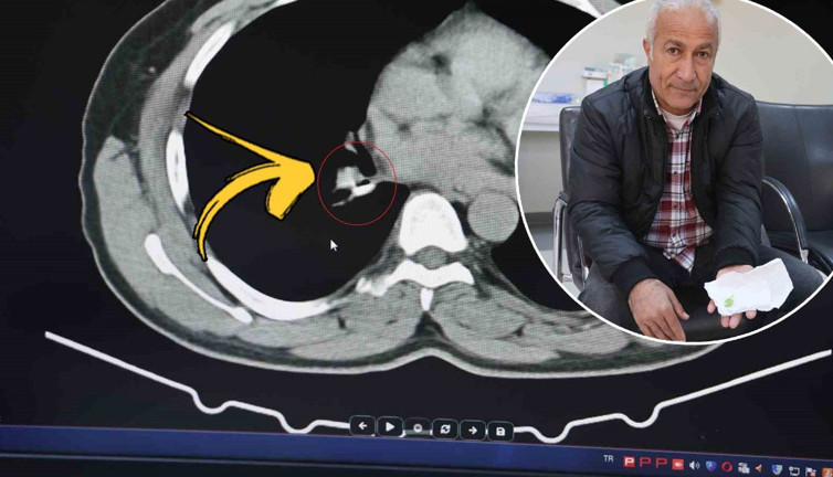 Öksürük şikayetiyle gitmişti: 1,5 yıl astım tedavisi gördü, gerçek bambaşka çıktı