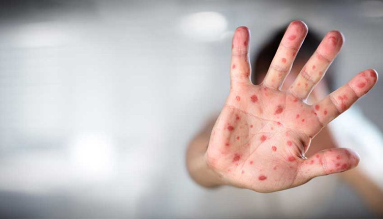 Zona hastalığına karşı etkili 3 bitki! Uzmana göre doğal iyileşme süreci