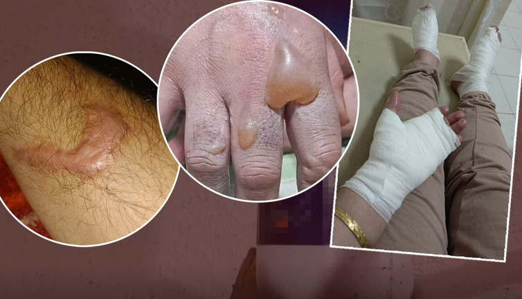 Lavabo açıcı adeta bomba gibi patladı! İki kardeşin vücudu yandı