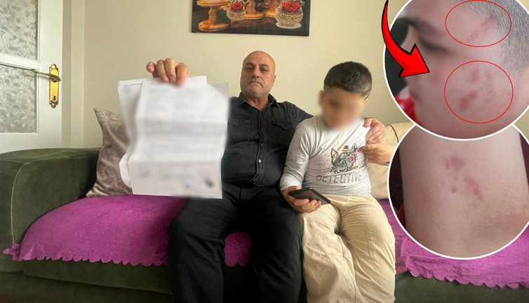 Öğretmenden otizmli çocuğa görülmemiş işkence: Vücudunda tam 54 morluk var