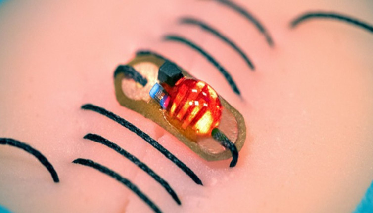 Akıllı dikiş devrimi! Enfeksiyonlara karşı erken uyarı