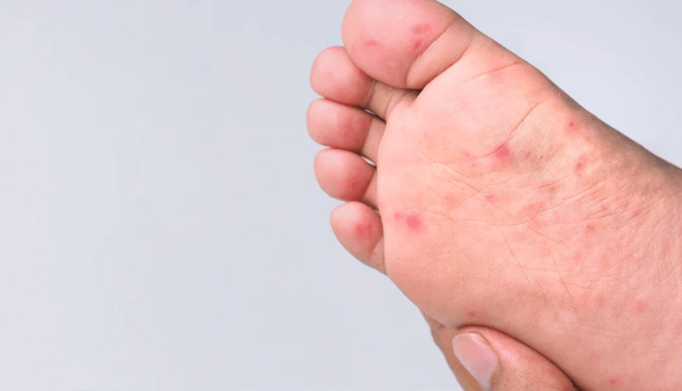 Çocuklardaki el ayak hastalığıyla ilgili uzmanlar aileleri uyarıyor