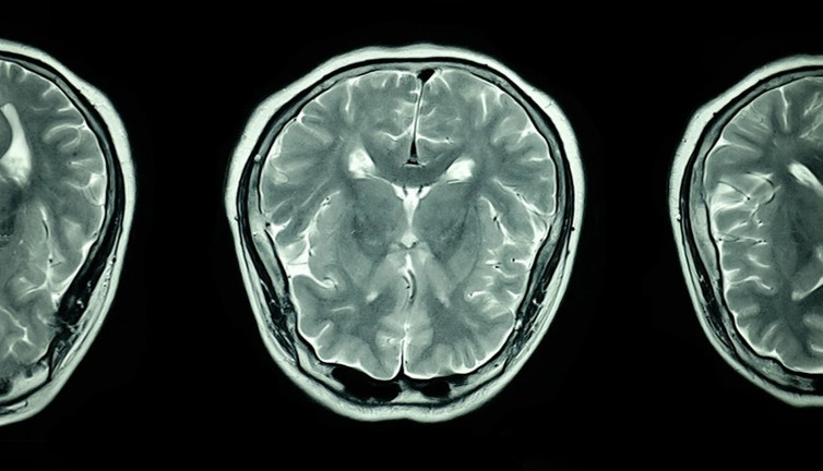 Felçten kurtuluşun anahtarı yapay zeka destekli dil köprüsünde mi? Uzmanlar anlatıyor