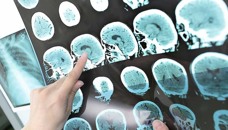 Beyin tümörüne karşı basit ama etkili bir test