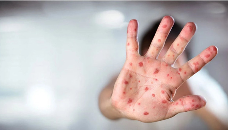 Kızamık salgını alarm veriyor! Uzmanlardan tatil ve aşı çağrısı