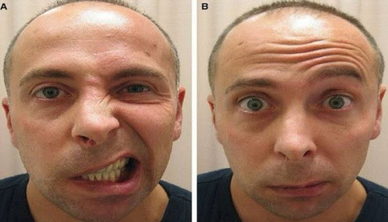 Botoks yüz felci yapar mı? Uzmanlar bilimsel verilerle açıkladı