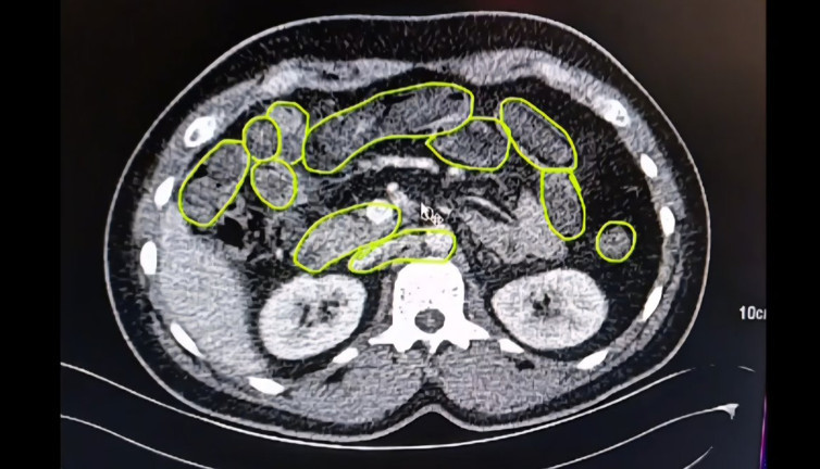 Mide ve bağırsaklarından uyuşturucu çıktı