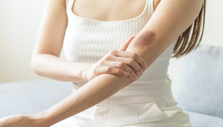 Cildinizdeki ortaya çıkan morluklara aman dikkat! Meğer o hastalığın belirtisiymiş