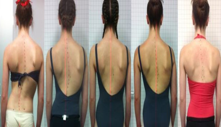 Kamburlukla ilgili uzmanlardan kritik öneriler! Skolyoz'u tarihe gömmek için mucize tavsiyeler