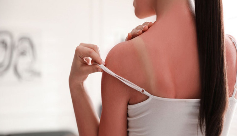 Cildiniz alarm veriyor! Güneş yanıklarına dikkat