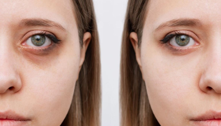 Göz altı morluklarının gerçek sebebi! Neden hep yorgun görünüyoruz?