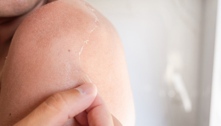 Cildiniz soyuluyorsa dikkat! Güneş yanığının gizli tehlikesi