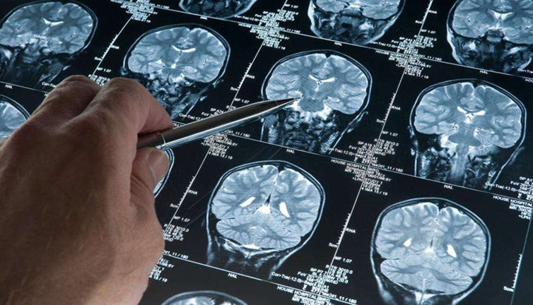 Alzheimer’a erken müdahalede umut! Bilimsel devrim
