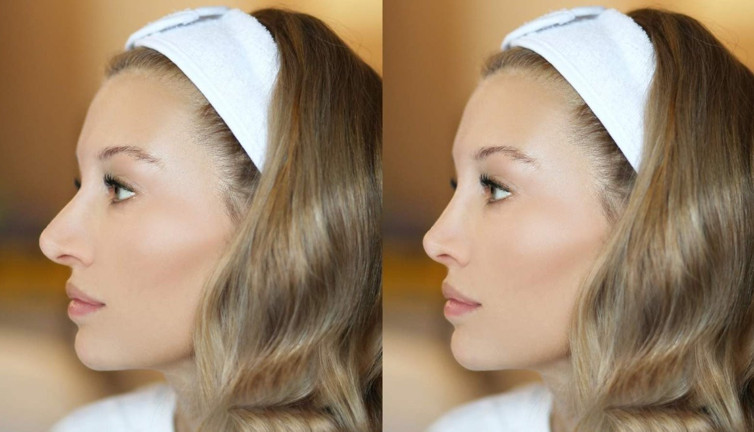 Yaz sıcağında burun ameliyatı riskleri! Uzmanlardan kritik uyarılar