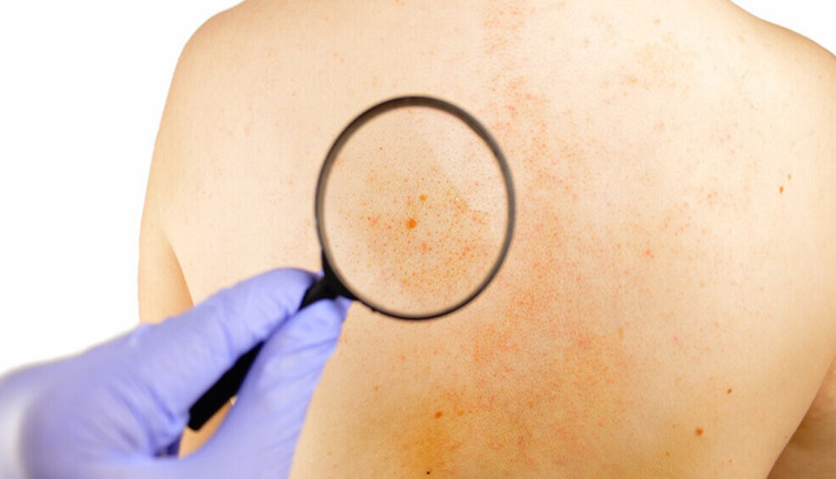 Cildinizdeki gizli tehlike! İki belirti hayatınızı değiştirebilir