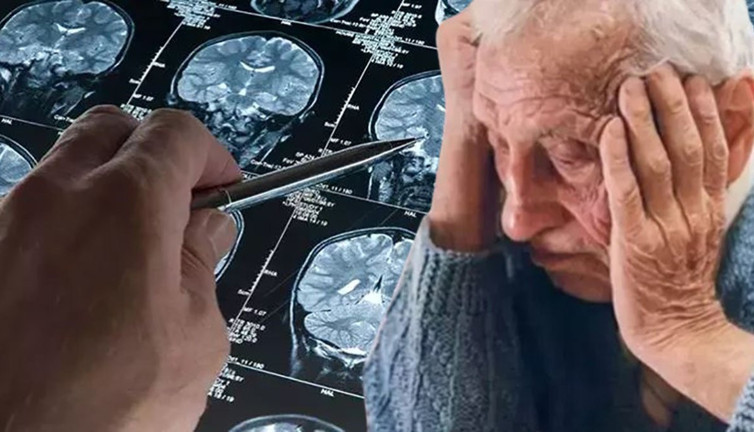 Alzheimer’ın 8 gizli tetikleyicisi ortaya çıktı! Kadınlar mı, erkekler mi daha tehlikede?