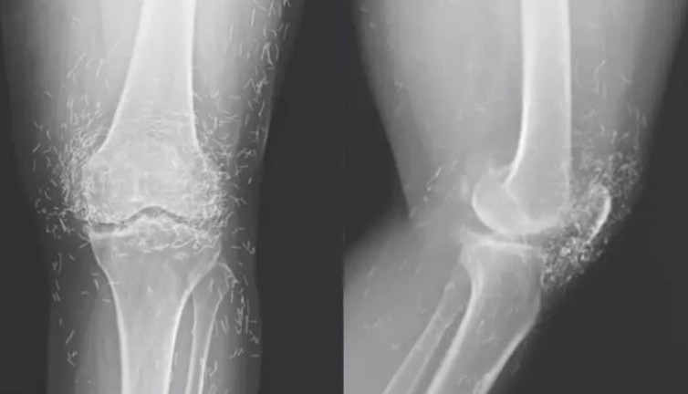 Diz ağrısı şikayetiyle hastaneye gitti: Röntgende ortaya çıkanlar doktorları şaşkına çevirdi!