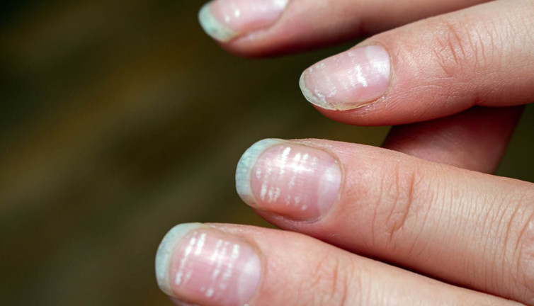 Demir eksikliğinin gizli yüzü! Vücudun alarmı