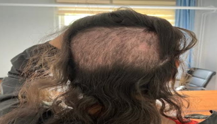 Otel odasında saç ekimi kabus oluyor! Uzmanlar uyarılarını sıraladı