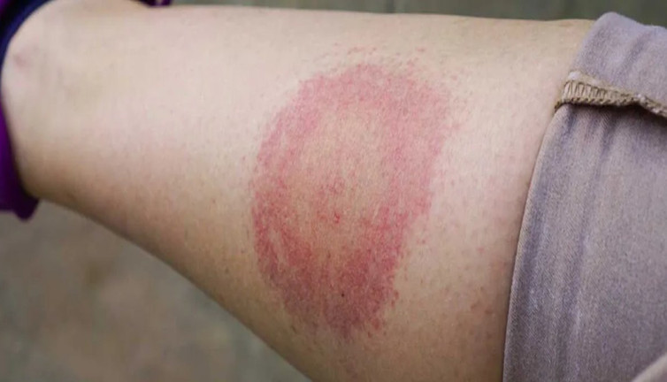 Lyme tedavisinde karanlık gerçek! Kalıcı semptomlar neden kaçınılmaz?